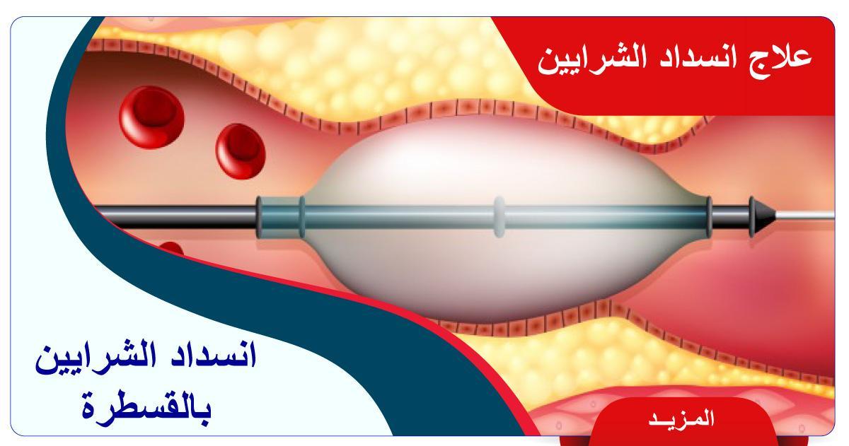 علاج انسداد الشرايين الطرفية بالقسطرة