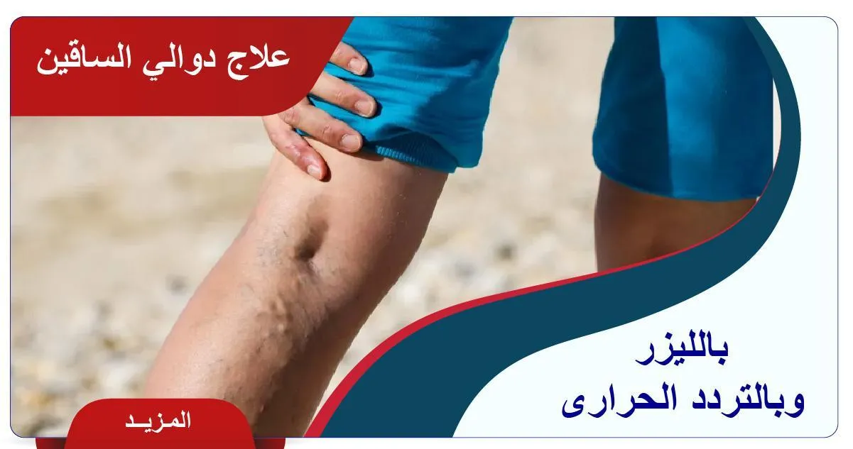 علاج دوالي الساقين